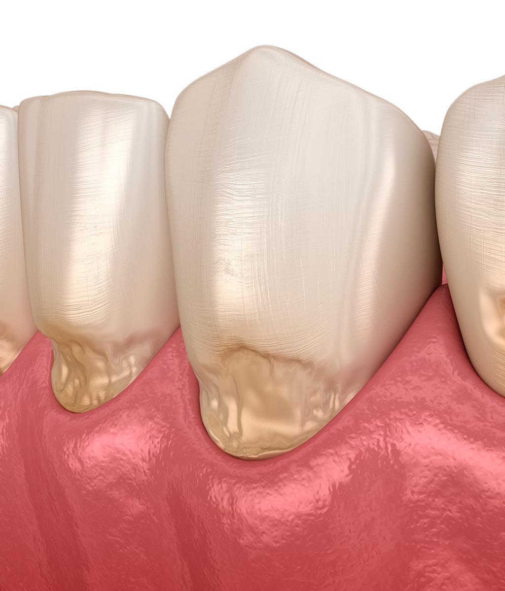 Desgaste dental por abfracción